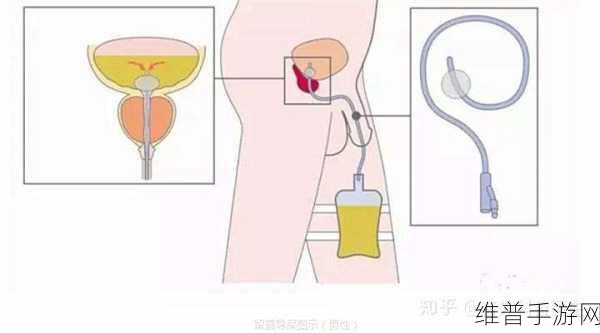 戴上尿锁不能尿知乎:1. 戴上尿锁的真实体验与心理影响