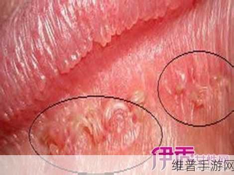 女性得阴挺病是怎么回事：1. 女性阴挺病的成因与防治措施解析