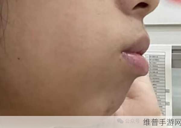 上下两张嘴都肿了：嘴肿双重困扰，生活质量降至谷底！